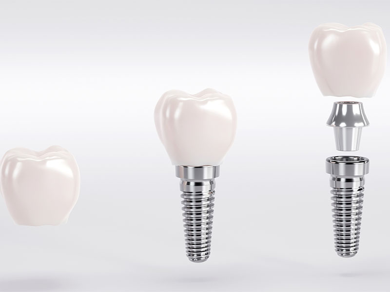Keramikimplantate in Bad Homburg