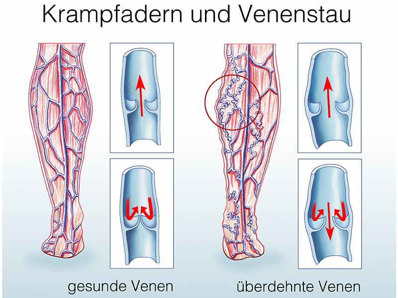 sichtbare Krampfadern und Venenstau an Beinen, deutlich erweiterte oberflächliche Venen bei Varizen für medizinische Information.