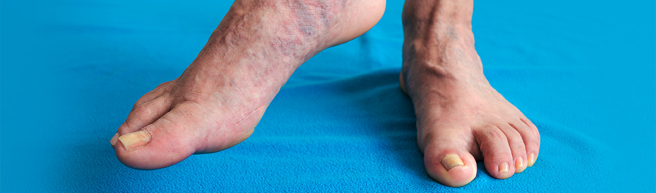 Krampfadern und erweiterte Venen an Füßen einer älteren Frau, Behandlung und Beratung in Phlebologie Hofheim.